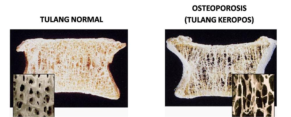 Lakukan Olahraga Ini, In syaa Allah Terhindar dari Oestoporosis